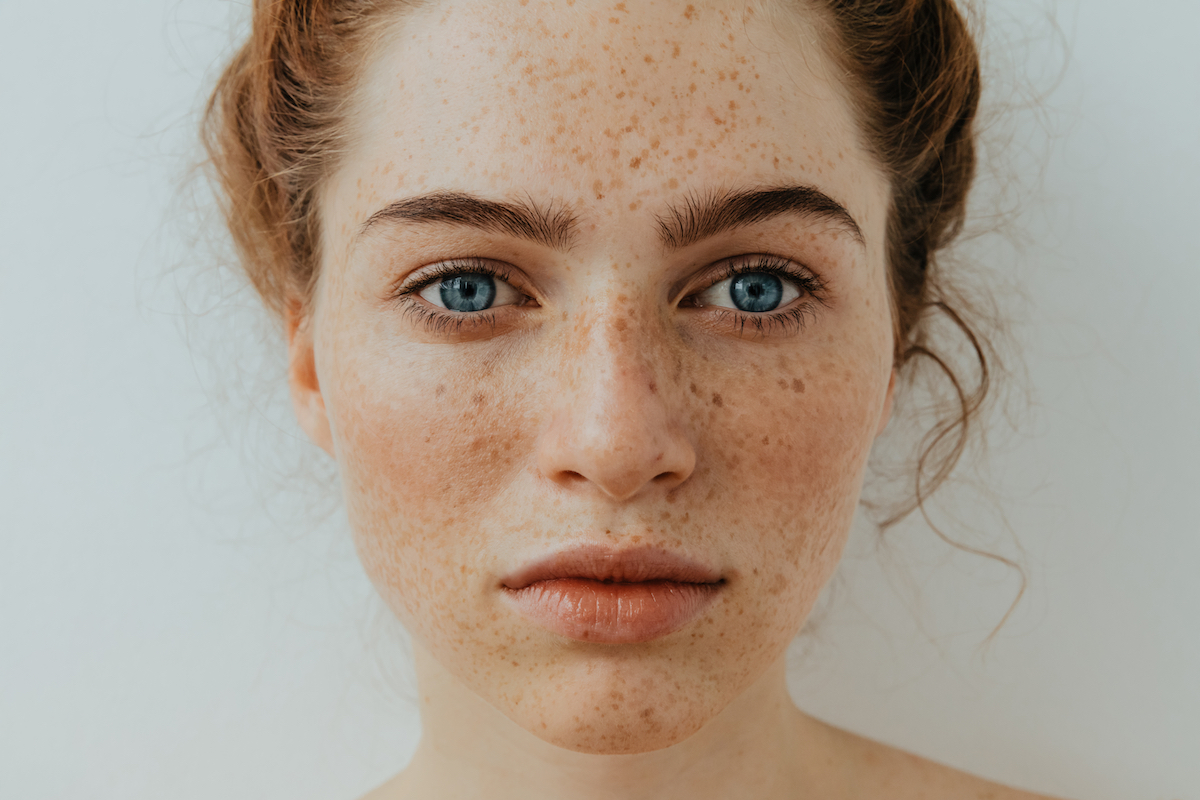 Freckles on Skin
